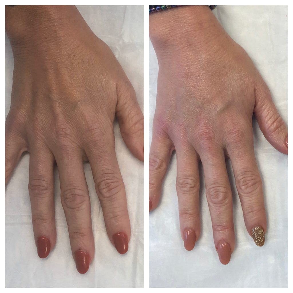 Side by side images of hands before and after a cosmetic procedure