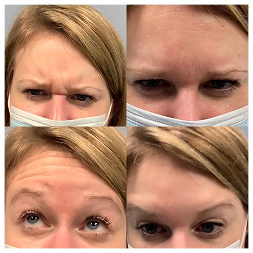 Side by side images of a woman's face before and after a cosmetic procedure