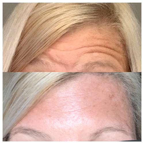 Side by side images of a woman's forehead before and after a cosmetic procedure