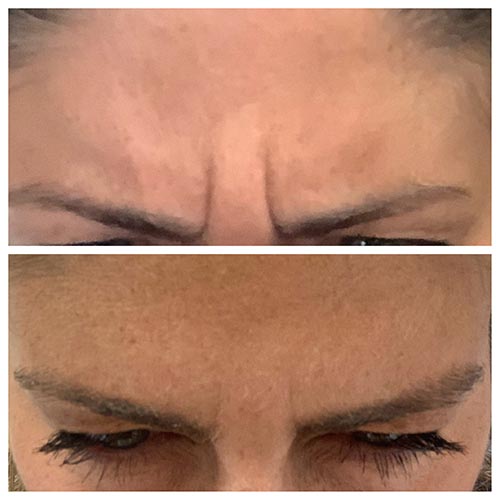 before and after of Botox results in glabella lines