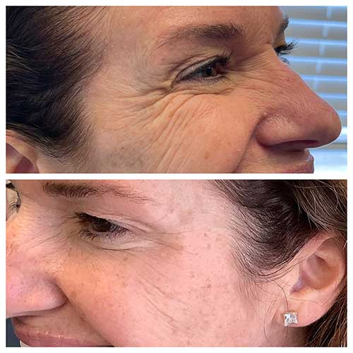 before and after comparison of botox in crows feet
