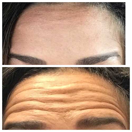 before and after of botox results in forehead