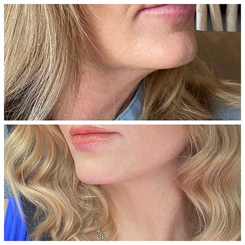 Jawline contour with Voluma and LavaSculpt