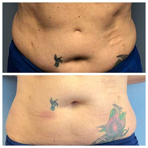 before and after of Lavasculpt in abdomen