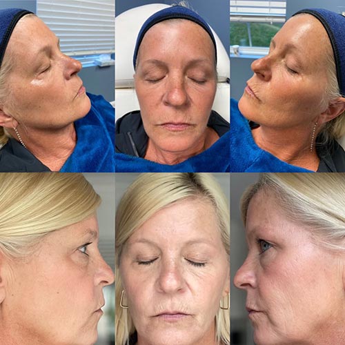 before and after the Obagi chemical peel