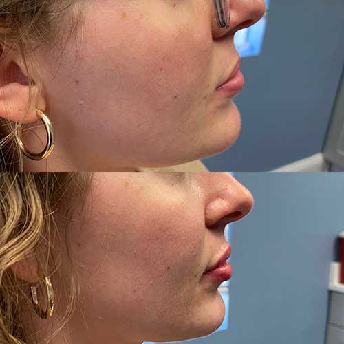 before and after profile view of lip enhancement with Vollure